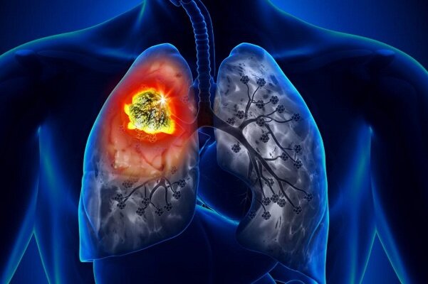 سیستم ایمنی معیوب منجر به سرطان ریه می شود