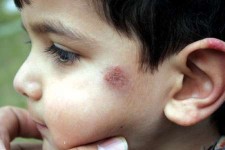  شهرستان گرمسیری قصرشیرین مخزن بیماری سالک است