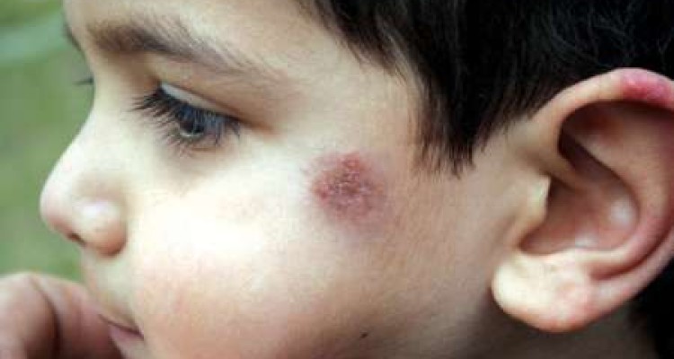  شهرستان گرمسیری قصرشیرین مخزن بیماری سالک است