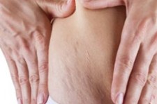 استرچ مارک یا ترک های پوستی و راههای پیشگیری و درمان آن 