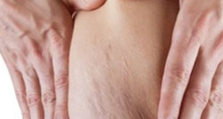  استرچ مارک یا ترک های پوستی و راههای پیشگیری و درمان آن 