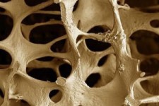 	نگاهی به یک بیماری شایع میان بانوان کرمانشاهی/ تاثیر نور شفا بخش در پیشگیری از پوکی استخوان 