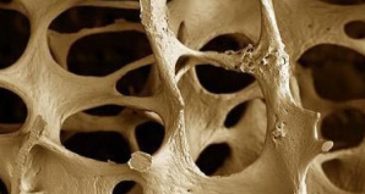 	نگاهی به یک بیماری شایع میان بانوان کرمانشاهی/ تاثیر نور شفا بخش در پیشگیری از پوکی استخوان 