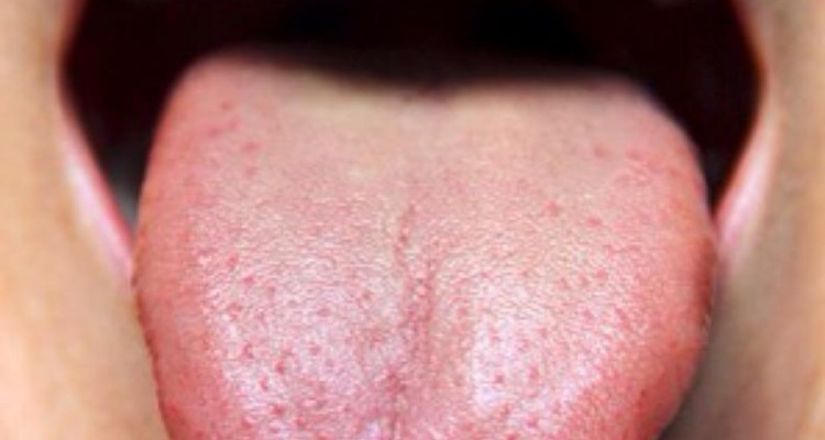  التهاب زبان (گلوسیت)؛ علل، نشانه ها و درمان بیماری التهاب زبان 