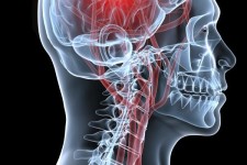  گام هایی برای جلوگیری از سکته مغزی 