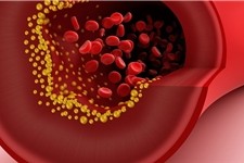 4 راهکار اساسی برای کاهش کلسترول