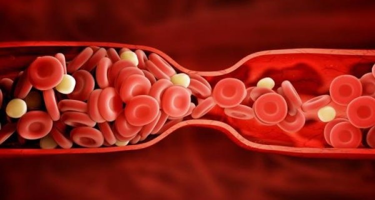 فاکتورهای پرخطر لخته شدن خون را بشناسیم