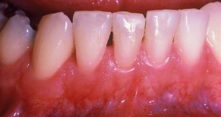  خطرات غیرمنتظره بیماری لثه