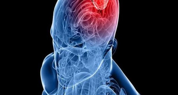 بازماندگان سرطان با ریسک متاستاز مغز روبرو هستند