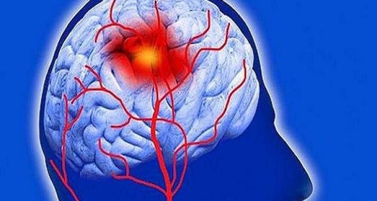 راه های پیشگیری از سکته مغزی را بدانیم