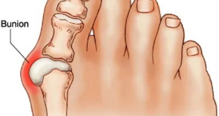  علت انحراف شست پا چیست؟