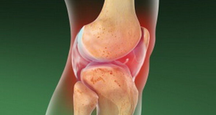  آرتریت سپتیک چیست و چه علائمی دارد؟