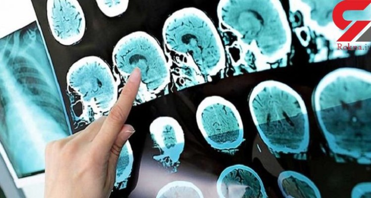 سلول‌های بنیادی، کلید درمان بیماری MS