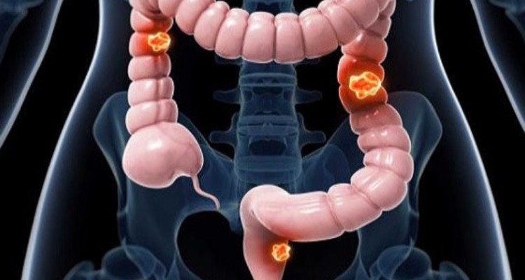 نوشیدنی های قندی و خطر افزایش دو برابری سرطان روده