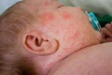  چگونه پوست عرق سوز شده را درمان کنیم؟ 