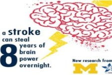 سکته، مغز را یک شبه هشت سال پیرتر می‌کند 