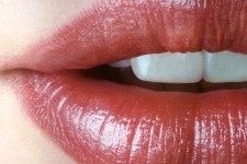  جراحی پروتز لب + مزایا و معایب پروتز لب 