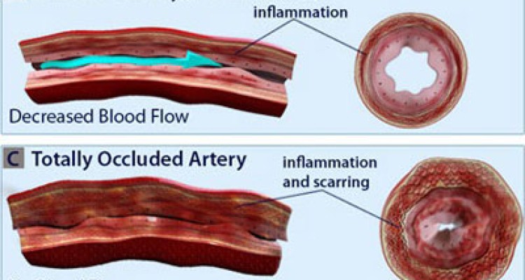  علل و انواع بیماری واسکولیت 