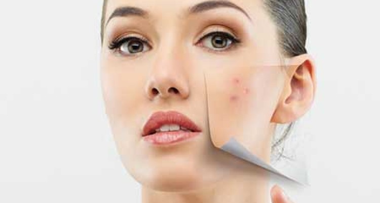  جوش صورت مان را در آرایش چگونه محو کنیم؟ 