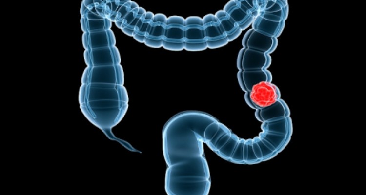  زنگ خطر سرطان روده 