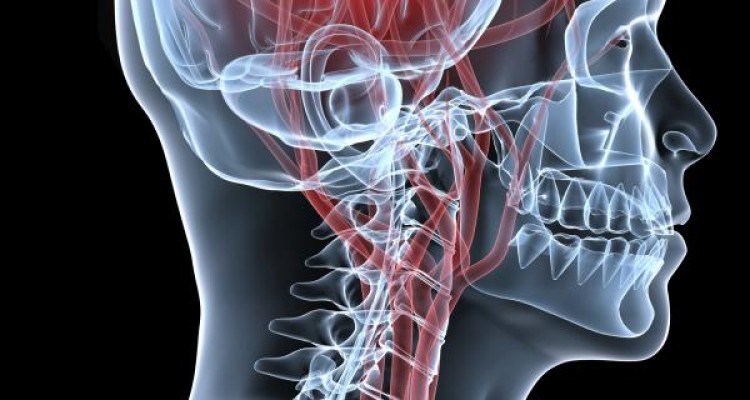  گام هایی برای جلوگیری از سکته مغزی 