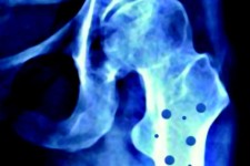  شاه کلیدی برای جنگ با پوکی استخوان 