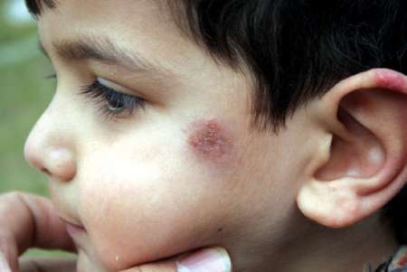  شهرستان گرمسیری قصرشیرین مخزن بیماری سالک است