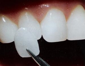 همه چیز در مورد لامینیت دندان / یک دندان پزشک: لامینیت ها طول عمر مشخصی دارند