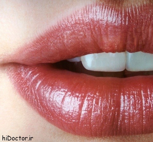  جراحی پروتز لب + مزایا و معایب پروتز لب 