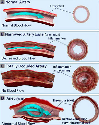  علل و انواع بیماری واسکولیت 
