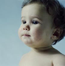  اگزمای کودکان 