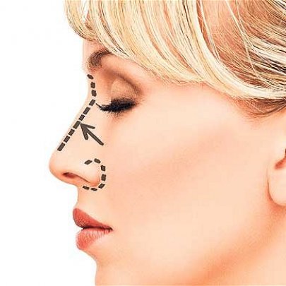 دستگاه‌های کوچک‌کننده بینی تاثیری بر زیبایی بینی ندارند 