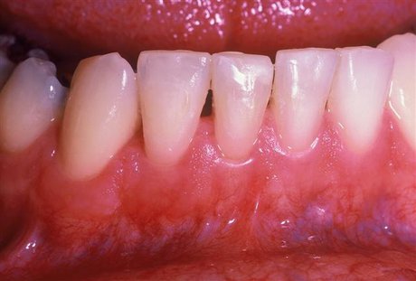 خطرات غیرمنتظره بیماری لثه خطرات غیرمنتظره بیماری لثه