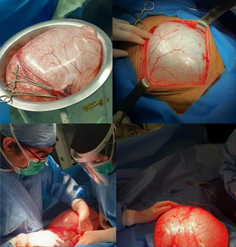 خارج کردن توده ۱۵ کیلوگرمی از شکم بیمار در بیمارستان دکتر معاون صحنه + تصویر