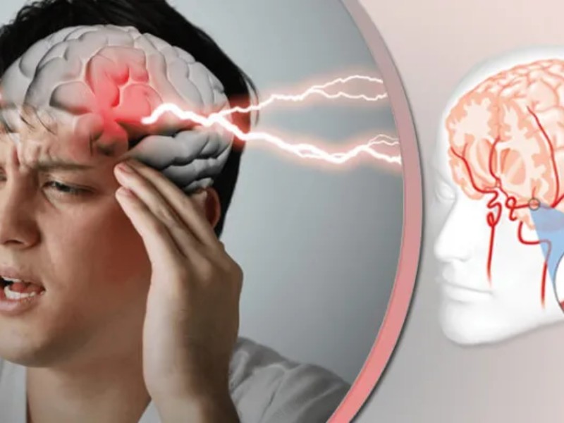  ۸۰ درصد از سکتههای مغزی قابل پیشگیریاند ۸۰ درصد از سکتههای مغزی قابل پیشگیریاند